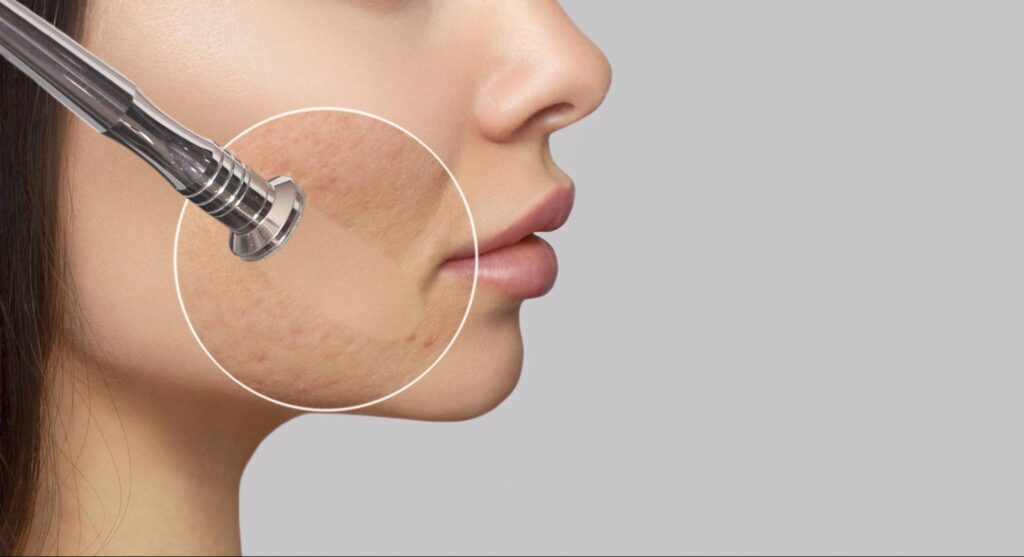 Diamond-tip microdermabrasion being performed for precise exfoliation and facial rejuvenation.