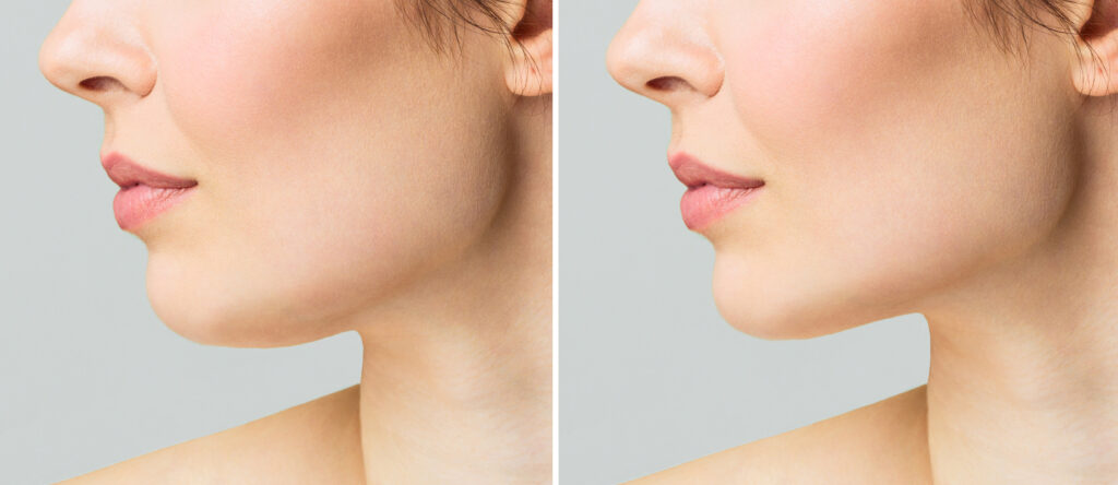 Before-and-after comparison of submental fullness treated with Kybella.