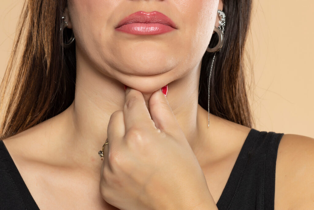 Image of a woman pinching submental fullness, illustrating the need for Kybella.