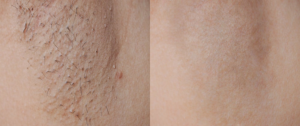 Before and after results of IPL hair removal showing smooth skin transformation.