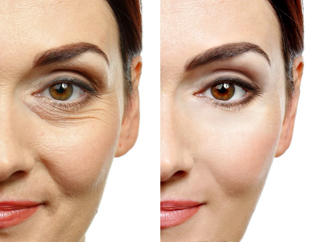 A close-up before-and-after comparison of a woman's face showing reduced wrinkles around the eyes after Botox treatment.